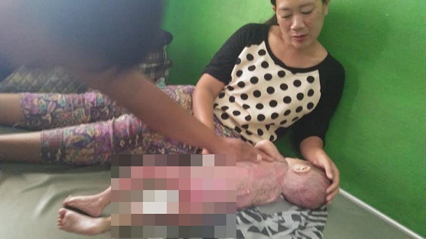 Kondisi Alenta Bilqis Bayi Penderita Gizi Buruk di Lampung Utara Makin Memprihatinkan