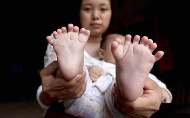 Unik, Bayi di Cina Ini Terlahir Dengan 31 Jari