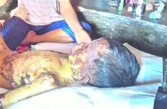 Sekujur Tubuh Risky di Dusun Kemuning Lampung Timur Terbakar, Keluarga Tak Ada Biaya Berobat