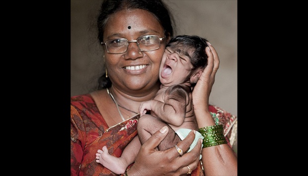Heboh Bayi Mirip Srigala di India, Kisah Memilukan Bagi Orang Tua